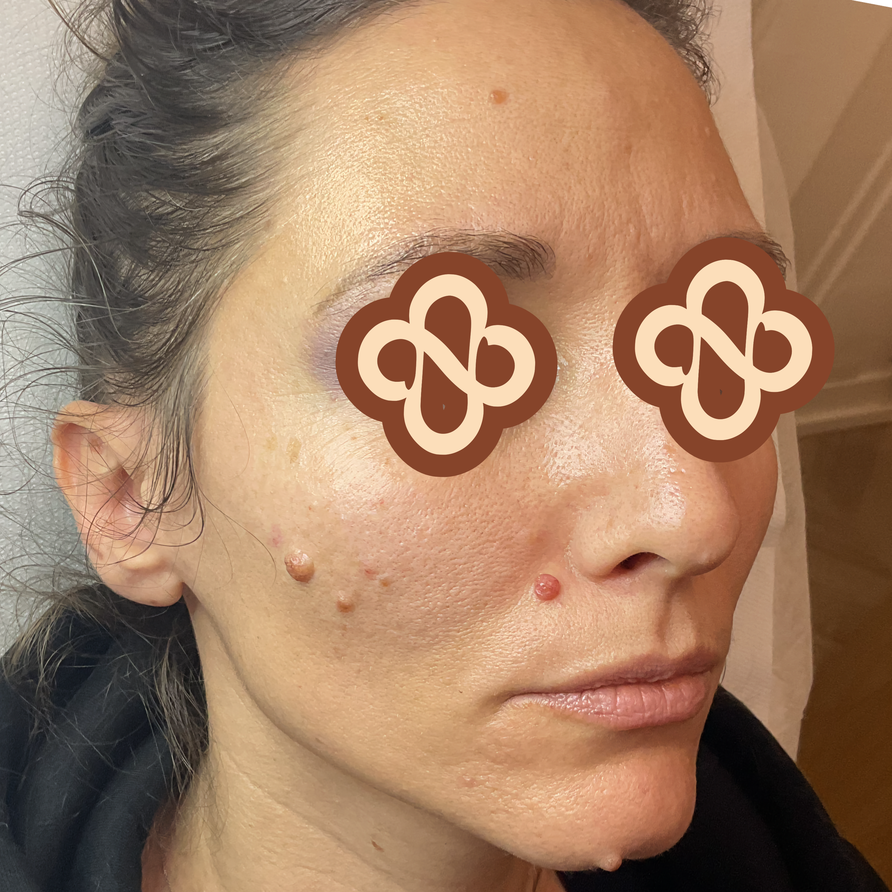 Result after treatment - Before