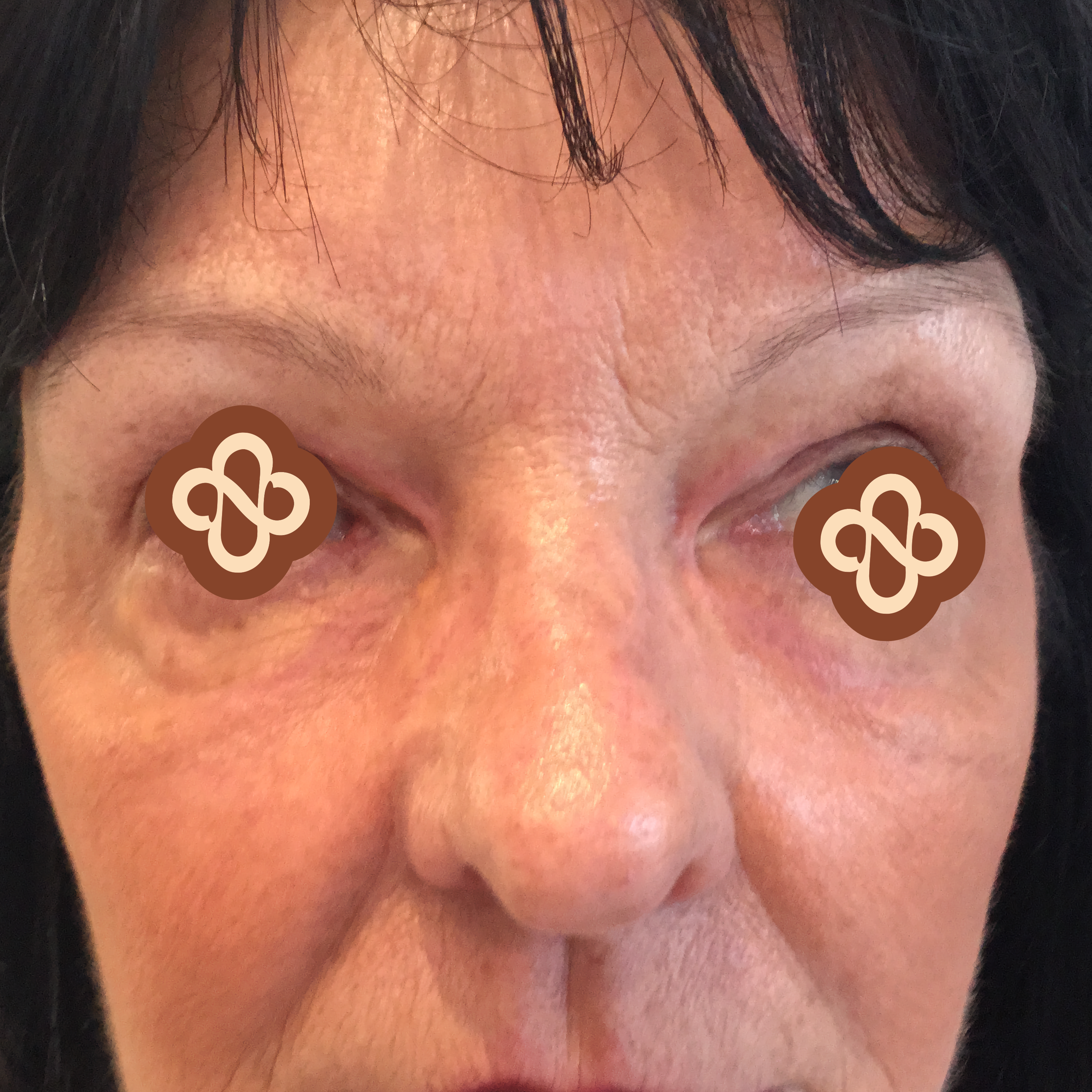 Result after treatment - After