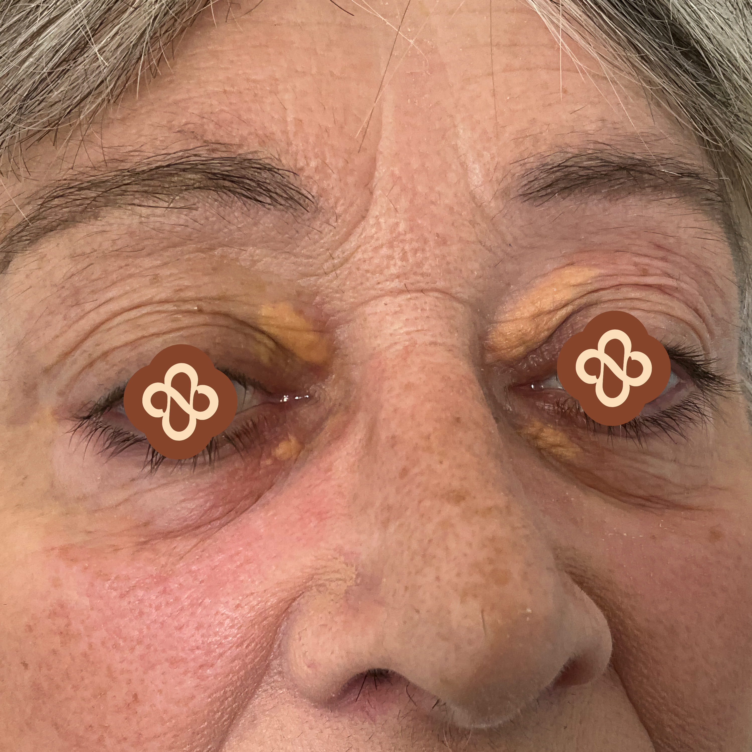 Result after treatment - Before